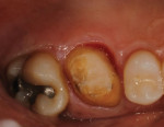 (3.) Occlusal view of the completed core buildup and laser crown lengthening.