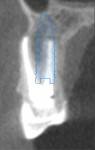 (5.) Virtual implant planning software image showing a cross-sectional CBCT view demonstrating the planned implant position in relation to the present anatomy.