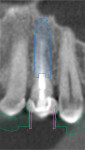 (7. AND 8.) Virtual planning views of the position of the implant in relation to the anatomy and the design of the surgical guide.