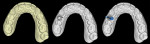 (10.) Virtual model of the arch with the current crown present, with the restoration and tooth removed, and with the implant placed, respectively.