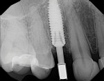 (24.) Radiograph showing the placement of the implant.