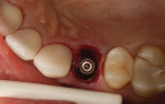 (25.) Occlusal view of the implant following placement.