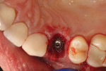 (26.) Occlusal view of the site following the placement of an allograft material around the implant.