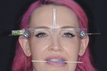 (5. THROUGH 8.) For communication with the laboratory, a complete series of preoperative photographs was acquired, including left and right lateral retracted views with the teeth apart, a frontal close-up maxillary anterior view, and a full face portrait with facial reference glasses and bite stick.