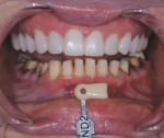 (10.) After the maxillary temporary restorations were placed, the mandibular teeth were prepared for all-ceramic crowns, as well as veneers on teeth Nos. 23 through 27, and a shade tab photograph was acquired.
