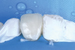 Fig 12. As performed during the wet-mockup, the clinician initially applied the chosen palatal layer to create the initial shell, followed by the selected enamel shade on top to complete the restorations. Clinicians must bear in mind, however, that colors and translucencies may be misrepresented under rubber dam isolation due to dehydration.