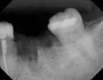 (1.) Radiograph acquired following extraction of a non-restorable mandibular first molar and site grafting with a calcium apatite material (OsteoGen® Bioactive Resorbable Calcium Apatite Graft, Impladent Ltd.). Note the radiolucency of the graft material immediately following placement.
