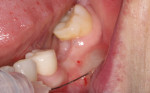 (4.) It is imperative that a band of attached gingiva of at least 2 mm is present on the facial aspect of any implant restoration. This can be determined by infiltrating anesthesia and monitoring the mucogingival line. The attached gingiva will remain fixed, whereas the mucosa will elevate from the underlying bone.