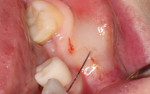 (5.) It is imperative that a band of attached gingiva of at least 2 mm is present on the facial aspect of any implant restoration. This can be determined by infiltrating anesthesia and monitoring the mucogingival line. The attached gingiva will remain fixed, whereas the mucosa will elevate from the underlying bone.