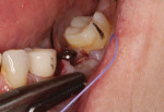 (15.) A periodontal sling suture was used to reposition the band of attached gingiva on the buccal flap from the slightly lingual aspect of the crest to the facial aspect of the healing abutment. To accomplish this, a reverse cutting, 3/8-circle needle was engaged on the mesial-facial aspect of the attached gingiva. After the suture was wrapped around the healing abutment without engaging the lingual tissue at all, the needle was reversed, engaging the distal-facial aspect of the attached gingiva, and again the suture was wrapped around the healing abutment without engaging the lingual tissue. A knot was tied on the mesial facial aspect. The exposed bone at the crestal aspect of the site was left untouched. Epithelium will fill that space at a rate of approximately 0.5 mm per day.