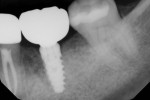 (27.) The final digital radiograph illustrates an implant-supported restoration in a healthy position with an excellent long-term prognosis.