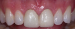 Fig 5. One approach to masking discolored dentition involves using a semi-translucent restoration with a semi-translucent resin cement.
