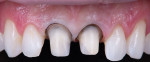 Fig 6. One approach to masking discolored dentition involves using a semi-translucent restoration with a semi-translucent resin cement.