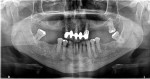 (3.) Pretreatment panoramic radiograph of a male patient demonstrating a maxillary anterior bridge with failing abutment teeth related to periodontal bone loss.