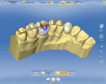 Figure 15  Sirona Dental Systems presents a completely overhauled software platform for its chairside CEREC® and laboratory inLab® CAD/CAM systems that features a re-designed, user-intuitive interface to help even novices to operate the system.