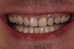 (1.) Pretreatment smile photograph demonstrating failing composite veneers on teeth Nos. 6 through 11.