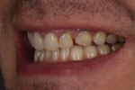(2.) Pretreatment left lateral photograph showing the large diastema between teeth Nos. 10 and 11 that had not been fully closed despite the substantial addition of material to tooth No. 11.