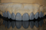 (4.) A wax-up based on the smile design was carried out by the practitioner.