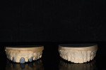 (5.) The wax-up was duplicated, and then every other tooth was removed from it. Similar to the injection molding technique, these two models would enable the fabrication of two sequential matrices—an initial one to place the final composite layer on the first half of the teeth and a secondary one to place the final composite layer on the second half.