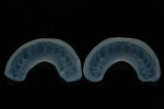 (6.) Intaglio view of the transparent matrices (Finopaste Crystal, Fino GmbH) that were produced. Note that these are open on the palatal aspect in order to facilitate the removal of excess composite and have no holes in the incisal aspects, which is different from the matrices used in the injection molding technique.