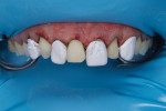 (12.) All of the teeth treated during the first round were isolated with PTFE tape to protect them during the second round, in which all of the remaining teeth were treated using the same protocol and materials.