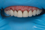 (13.) Intraoperative view following placement of the second round of composite veneers. The primary anatomy would require very little correction.