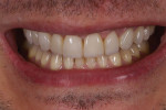 (14.) Postoperative full smile photograph demonstrating the improved lengths and proportions of the teeth.