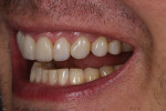(15.) Postoperative left lateral photograph showing that the diastema between teeth Nos. 10 and 11 is fully closed.