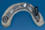 Fig 17. The bar was positioned in the printed denture. Note a lab analog was temporarily attached to
allow retrieval before bonding the bar into the printed denture.