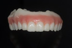 Fig 21. The “taco shell” denture.