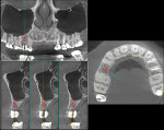 Fig 4. Preoperative CBCT.