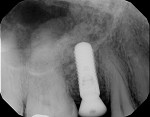 Fig 13. Radiograph of simultaneous implant
placement with maxillary sinus augmentation.
