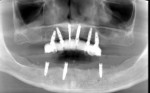 (1.) Pretreatment panoramic radiograph demonstrating three failing implants in the mandibular arch. The patient originally had five mandibular implants retaining an overdenture, but two had already failed.