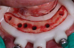 (13.) The implant osteotomies were prepared through the surgical guide, and then it was removed from the mouth.