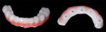 (22.) The 3D printed provisional hybrid prosthesis following accenting of the teeth with a light-cure staining kit and the facial aspects of the gingival areas with pink composite.