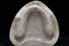 Figure 11  Removing the wax contour on the mandibular incisal edge will reduce the OVD and may flatten the Curve of Spee.