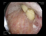 Fig 3.
Endoscopic
view of
part of the
foreign
body showing
some of
the dental
units on the
prosthesis.