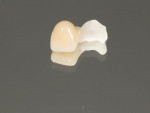 (5.) Extraoral view of the final zirconia fixed partial denture prior to delivery.