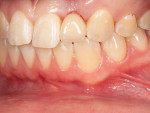 (7.) Close-up retracted left lateral view of the zirconia resin-bonded fixed partial denture at the time of delivery.