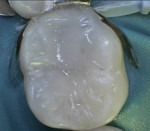 Fig 8. Tooth No. 19 restored with nanohybrid resin composite using etch-and-rinse bonding technique (photograph courtesy of Juliana Barros, DDS).