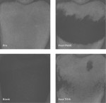 Fig 1. Example microscope images of biofi lm-covered black buccal crown surfaces before
treatment (“Pre”) and after treatment with PSQS nozzle (“Post PSQS”) and after treatment
with TOIS nozzle (“Post TOIS”). “Blank” image shows the black sample without biofi lm.