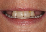 Figure 4  Composite mock-up of veneers Nos. 7 through 10 after extractions of cuspids and posteriors.
