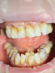 (3.) An increment of gingiva-shade composite was placed without etching and bonding and cured to determine the most appropriate shade and thickness for placement of the final restorations.