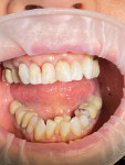 (7.) View of the composite restorations after they were shaped into emergences appropriate to accept pink composite.