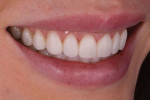 (11. AND 12) Right and left lateral smile photographs of the provisional restorations.
