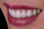 (17. AND 18.) Posttreatment right and left lateral smile photographs.