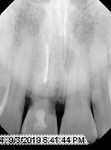 Fig 2. Preoperative periapical
view of tooth No. 8.