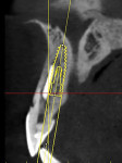 Fig 3. Preoperative CBCT view of tooth No.
8.