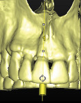 Fig 5. 3D view from the CBCT.