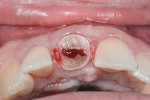 Fig 6. The crown portion of the tooth was removed, and a mesial-to-distal groove was made
with a high-speed fissure bur.